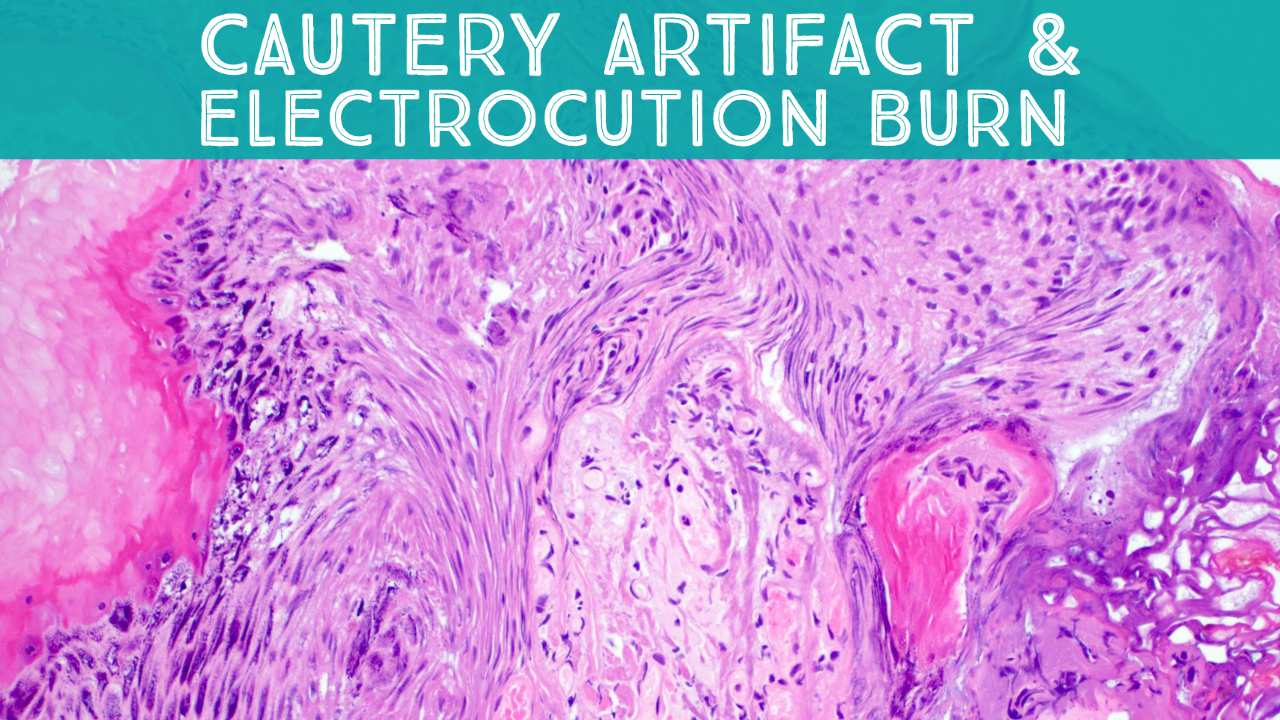 Cautery Artifact & Electrocution Burn (video) KiKo XP